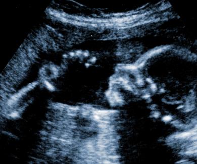Ultrasound image of a fetus